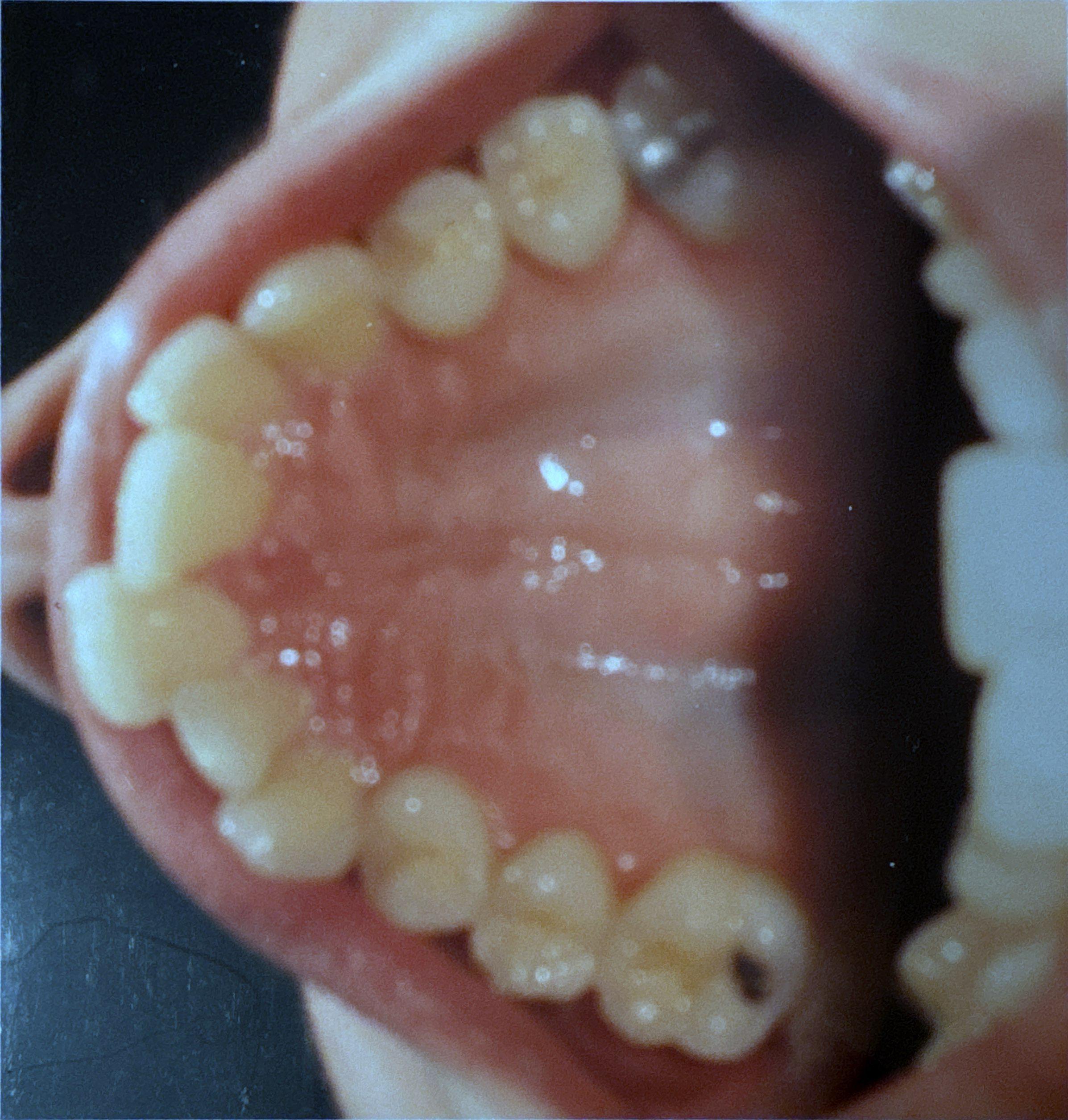 Teeth transformation before Invisalign